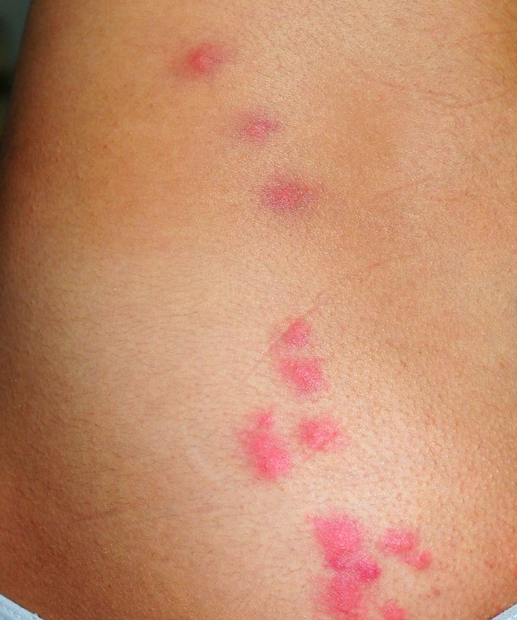 Bedbug bites on woman's back and buttocks