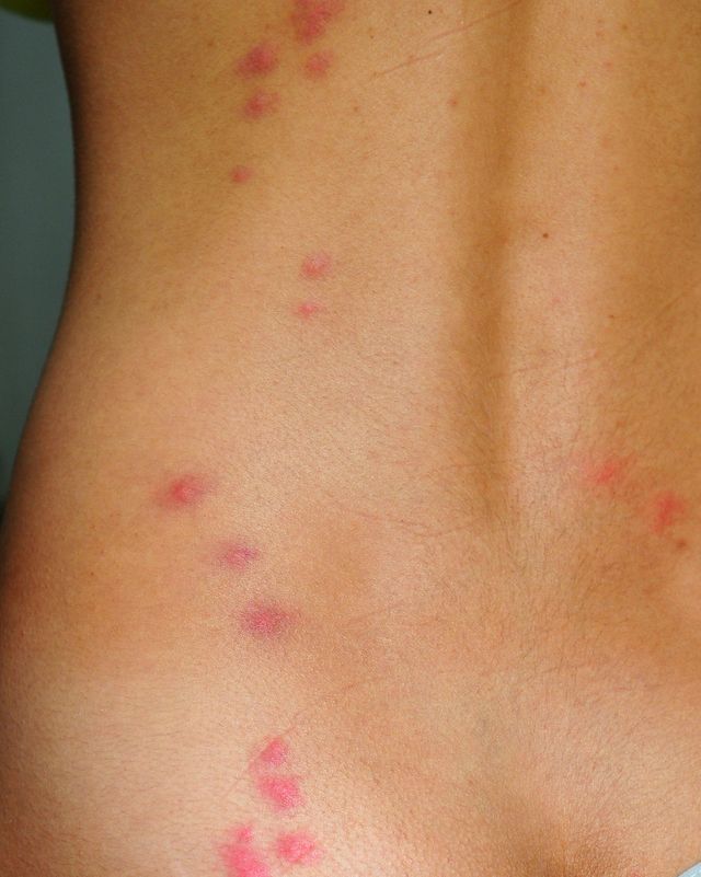 Bedbug bites on woman