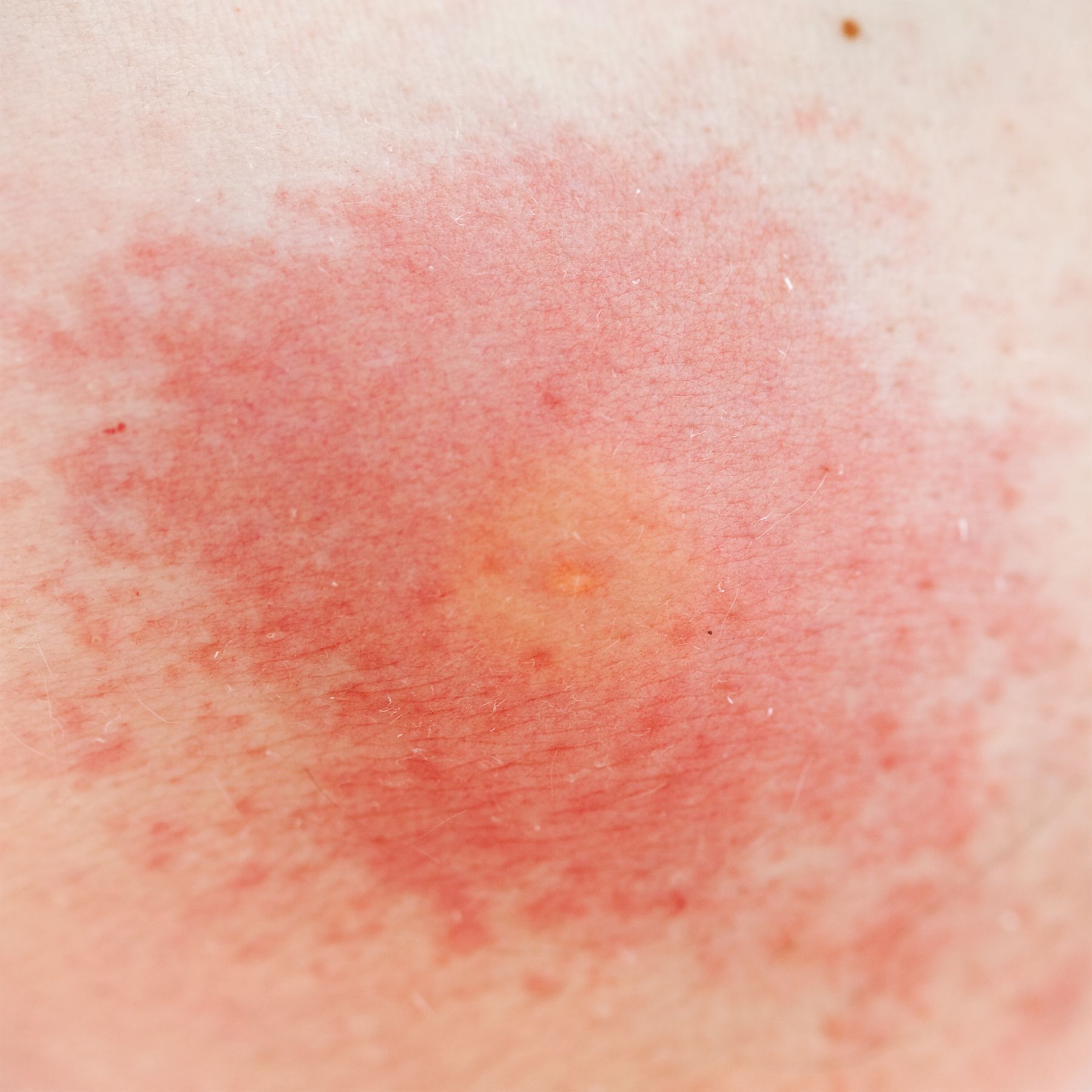 red rash from bug bite        <h3 class=
