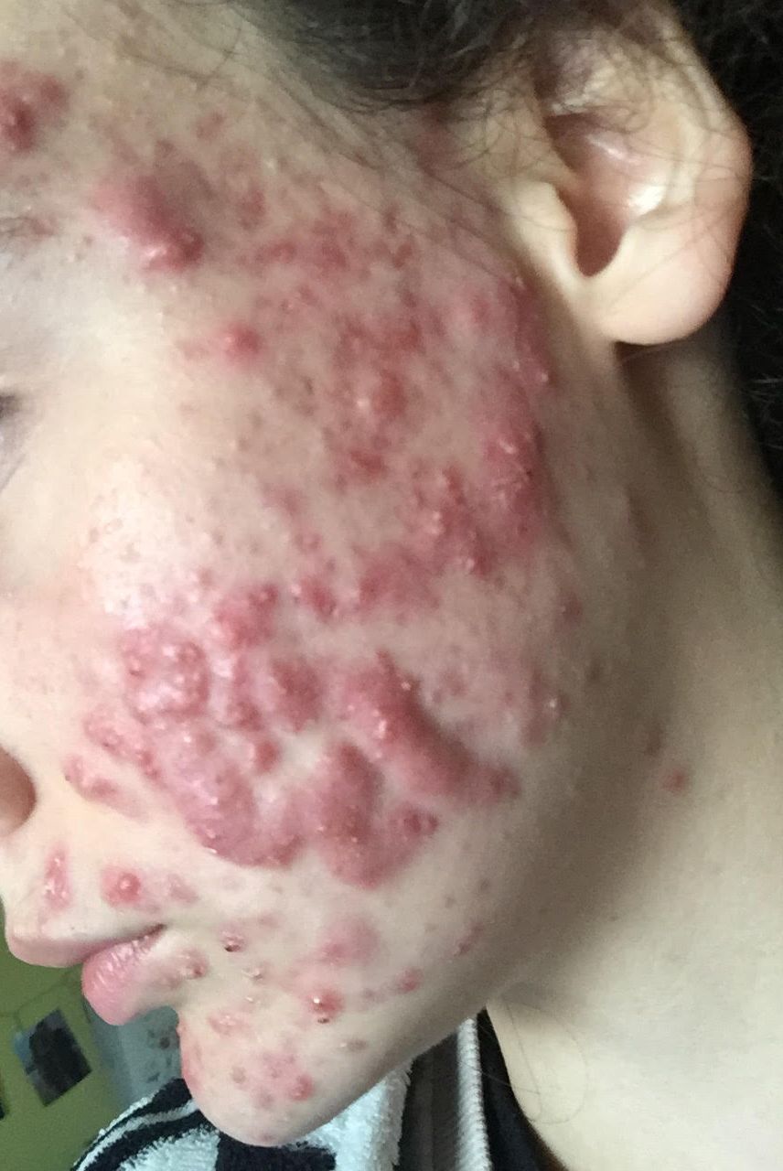 accutane before and after chest