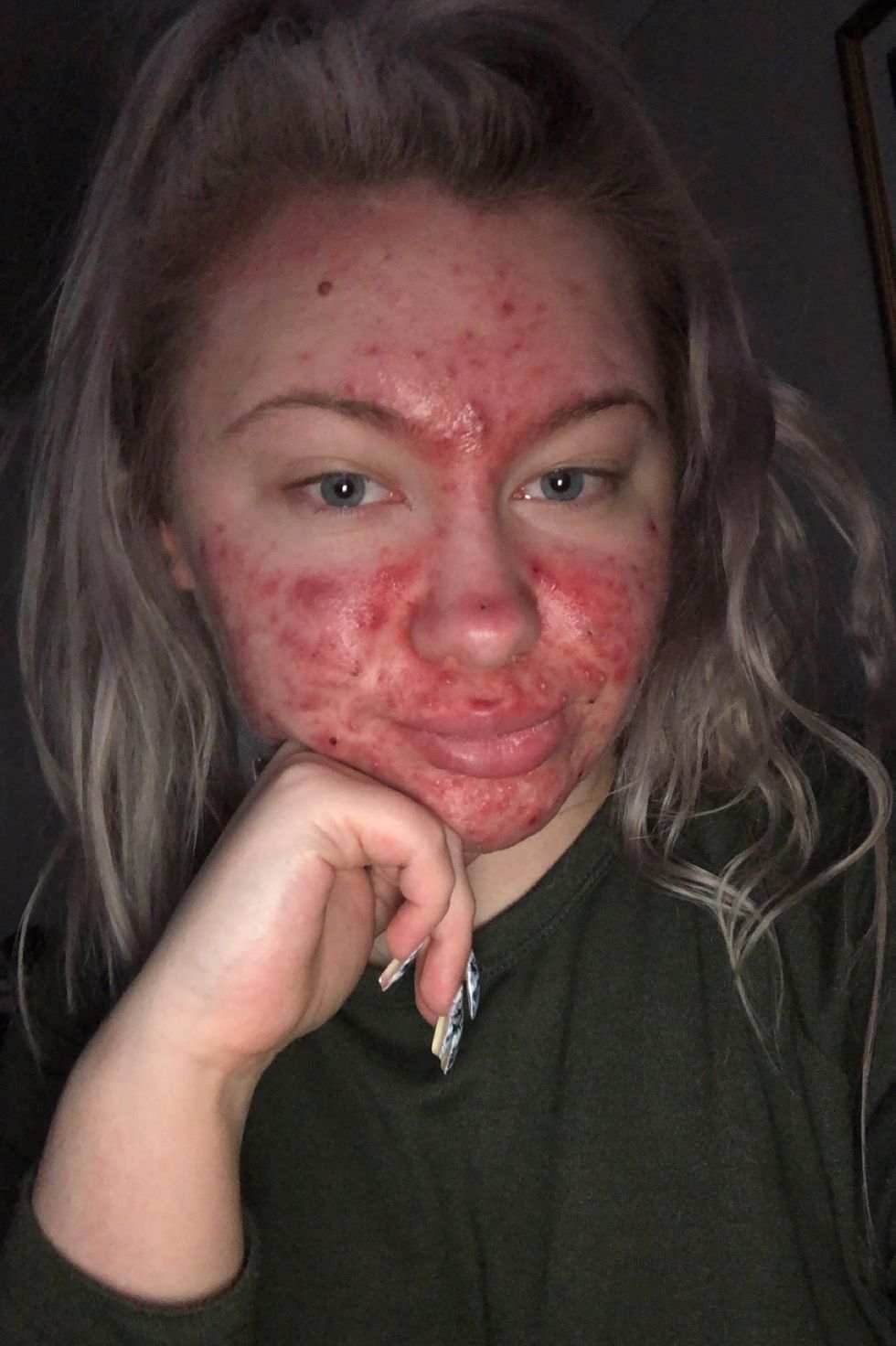 Accutane Before After: 9 Women on Isotretinoin Side Effects