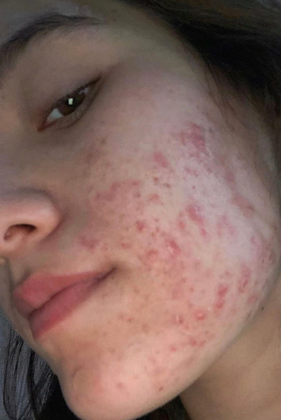 Accutane Before and After: 9 Women on Their Isotretinoin Side Effects Accutane Before and After: 9 Women on Their Isotretinoin Side Effects