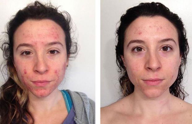 Larell Scardelli before and after holistic dermatology