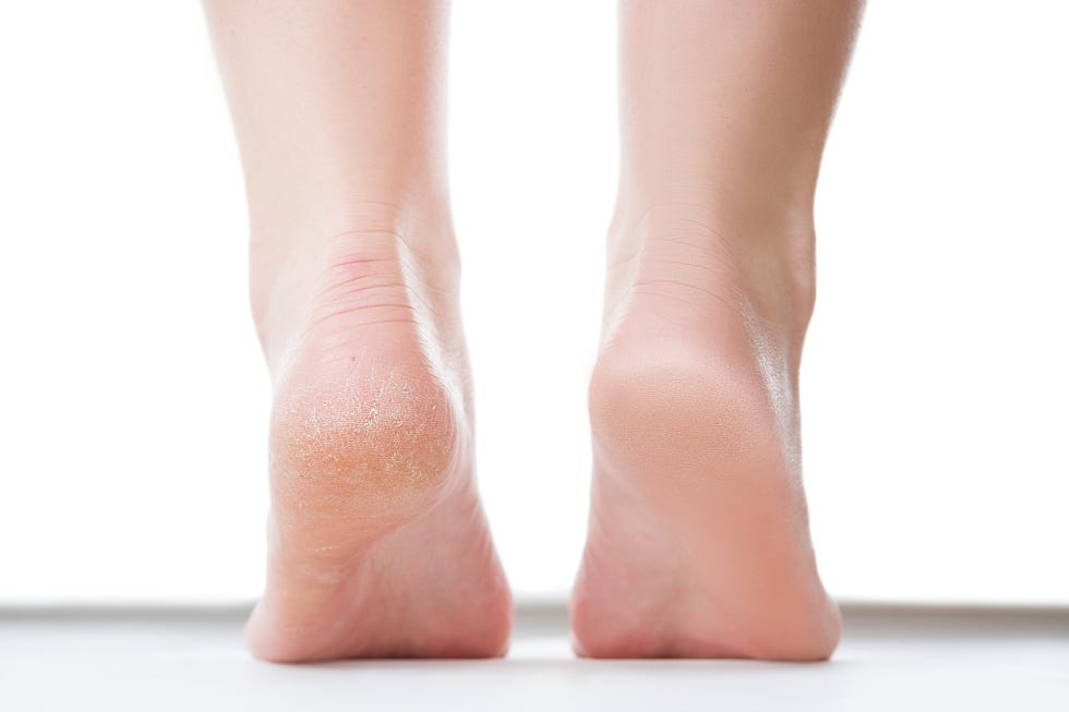 before after feet care concept, female foot, chiropody isolated on white background