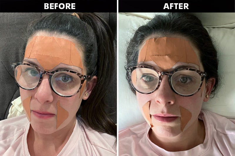 comparison of two photos showing a person wearing frownies wrinkle patches before going to bed and after going to bed