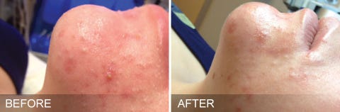 Before and After HydraFacial Before and After HydraFacial chin area
