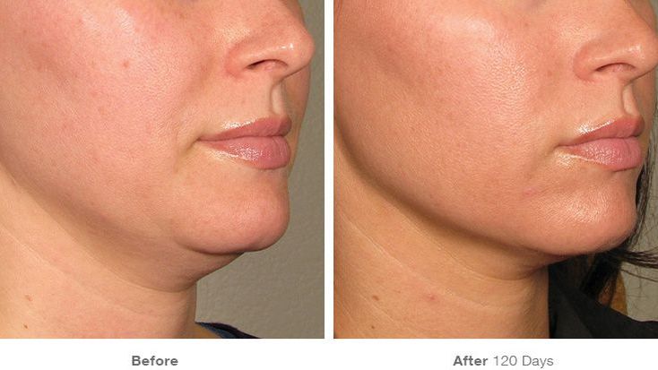 best facial laser treatments