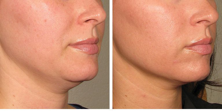 Laser Skin Tightening: What Is It and How Long Does It Last? - Laser NY
