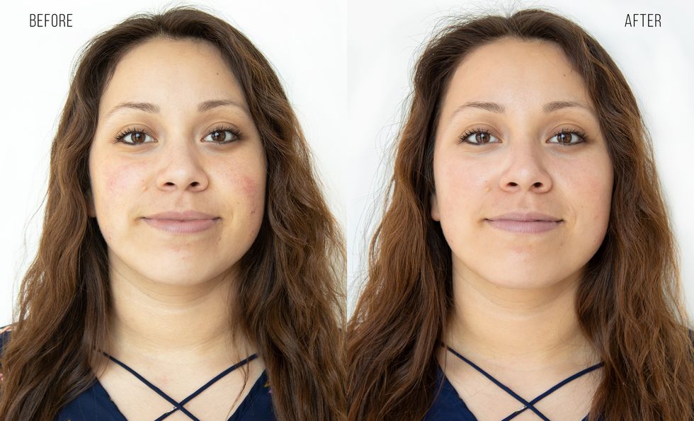 before and after photo of HydraFacial 