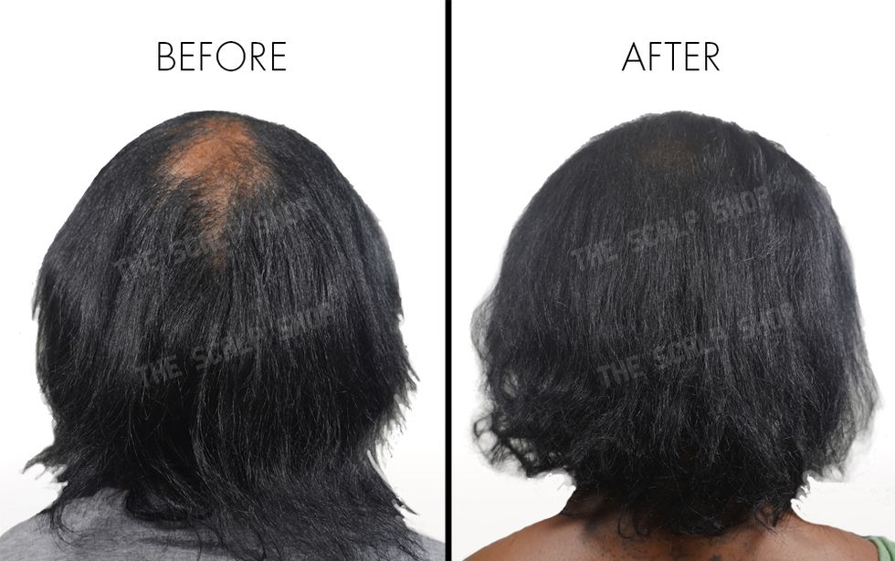 before and after of seywonh at the scalp shop