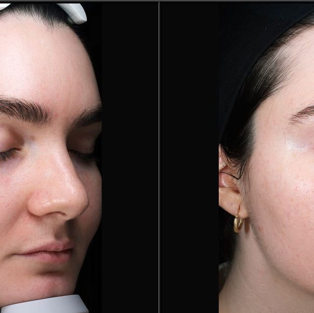 two images of a woman's face showing the before and after results of skinvive