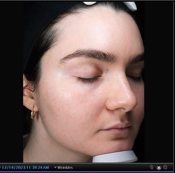 Skinvive Before and After two images of a woman's face showing the before and after results of skinvive