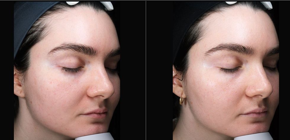 two images of a woman's face showing the before and after results of skinvive