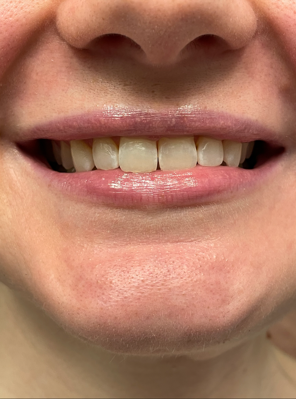 snow teeth whitening testing, a photo of the tester's teeth before use