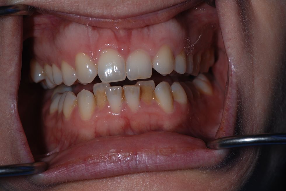 a person's mouth with teeth showing