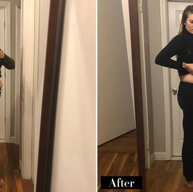 I Tried SculpSure Fat-Burning Laser Treatment After Giving Birth