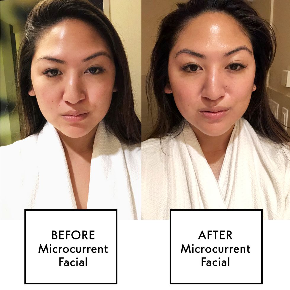 Microcurrent Facial Before and After