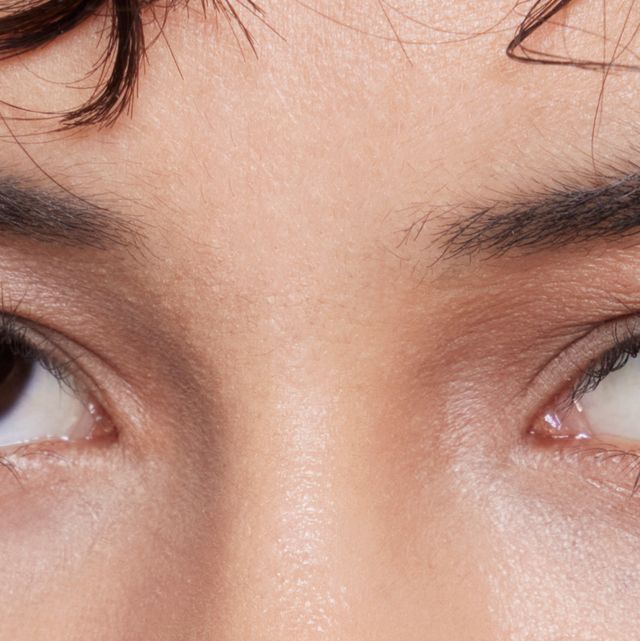 What Causes Yellow Circles Under Your Eyes?