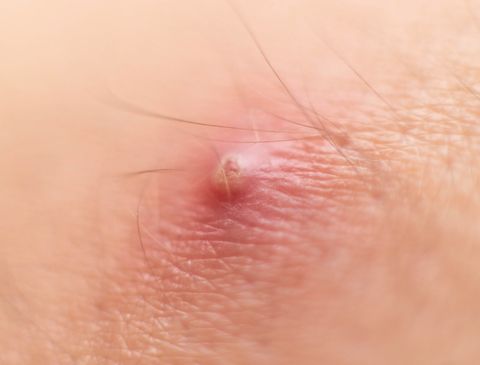 Signaal Hoogte Glans A Photo Guide To Raised Skin Bumps - Red Moles, Cysts, And More