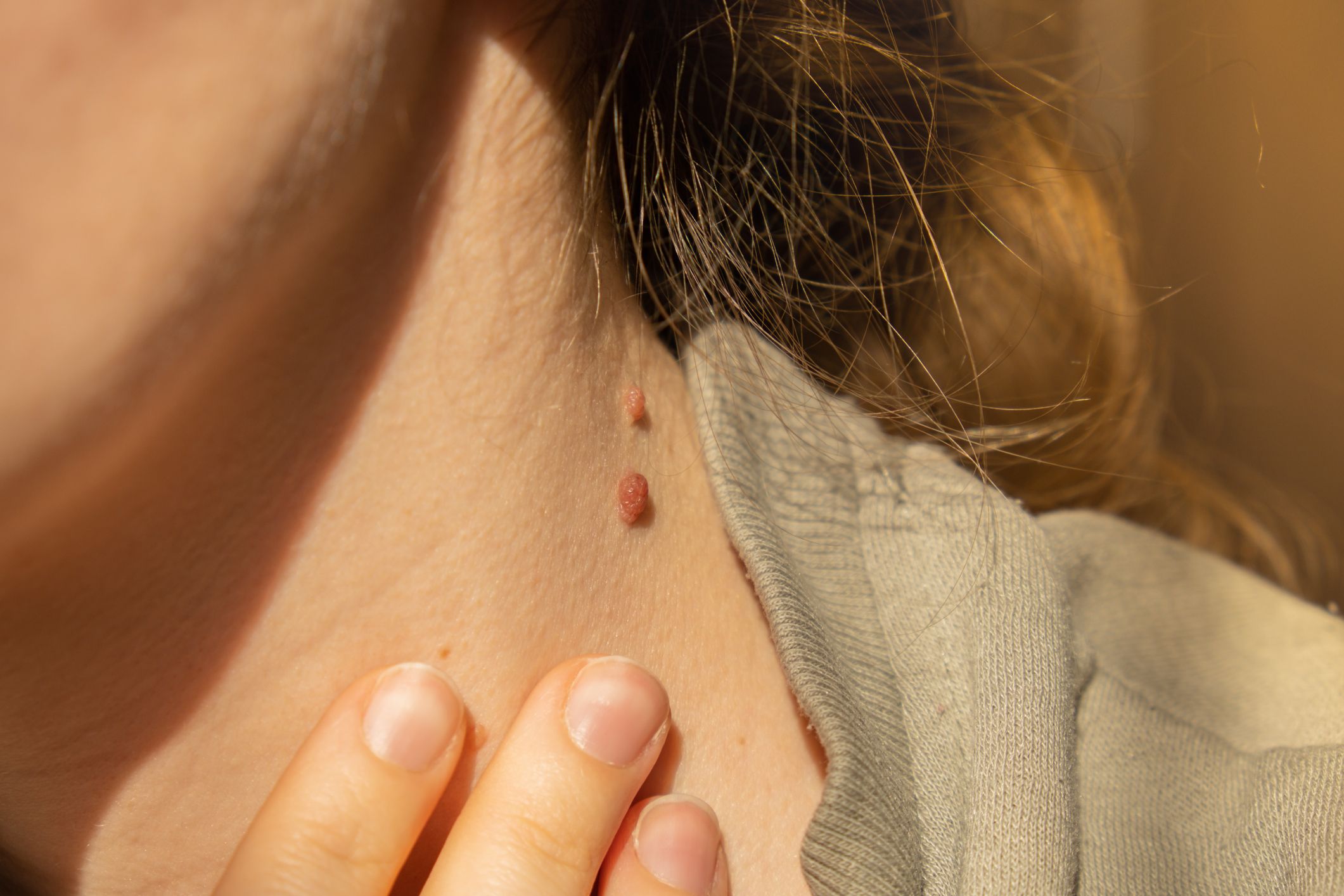 Skin Tag Removal–How to Safely Remove Skin Tags