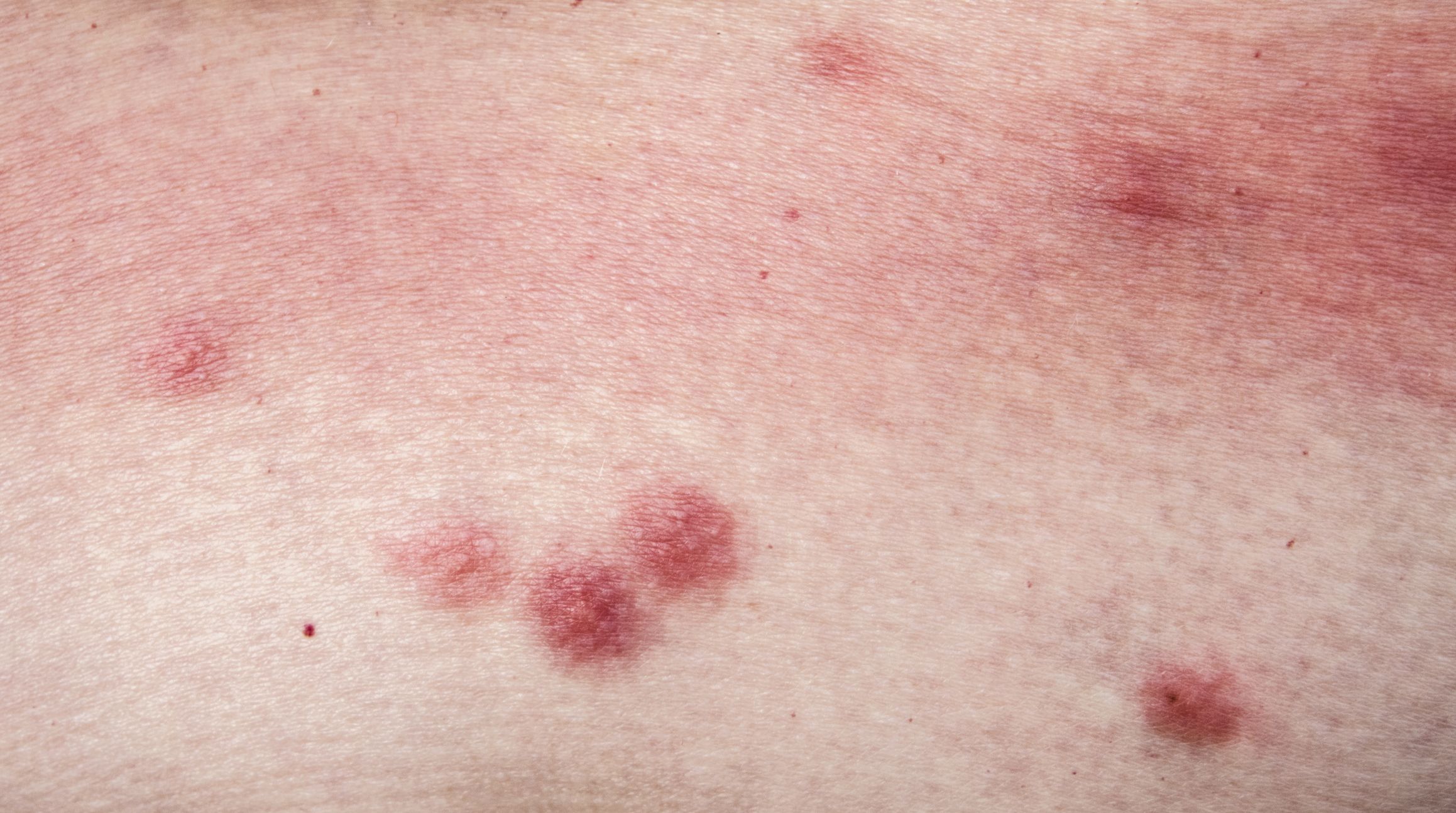 little red dots on skin bug bites