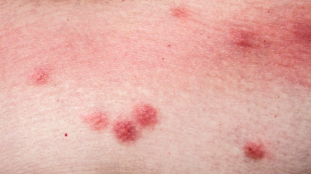 14 Common Bug Bites - Identifying Insect Bites Pictures