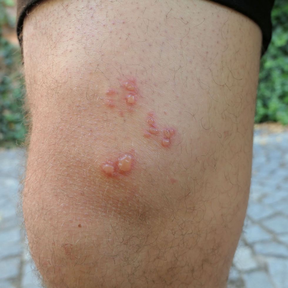 Man Bitten by Spider As He Slept Left in Immense Pain, Covered in Rash