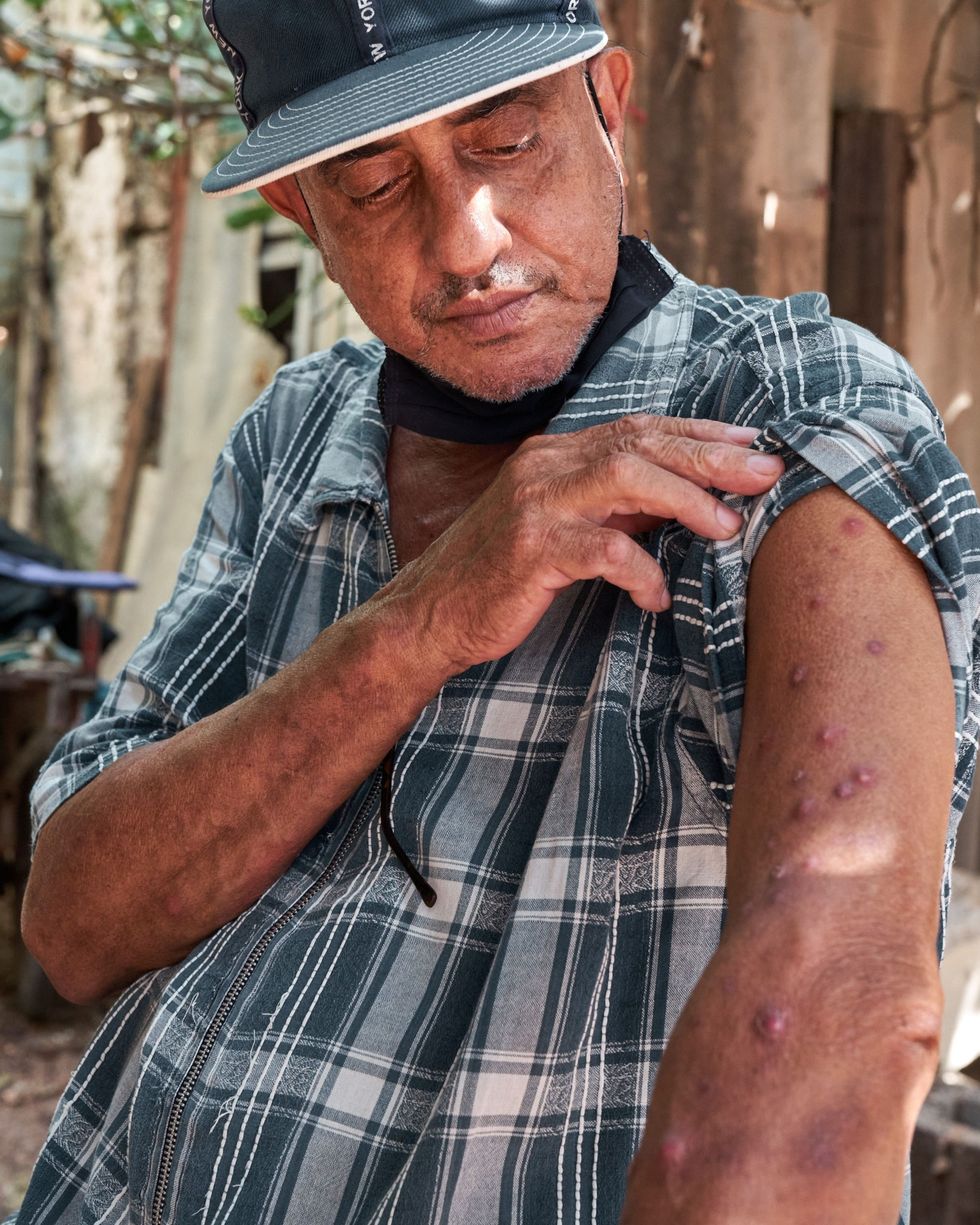 Flix Soto 68 toont de uitslag op zijn bovenarm De medicijnen die hij van zijn artsen kreeg voorgeschreven leken niet aan te slaan dus koos hij voor een behandeling met kruiden