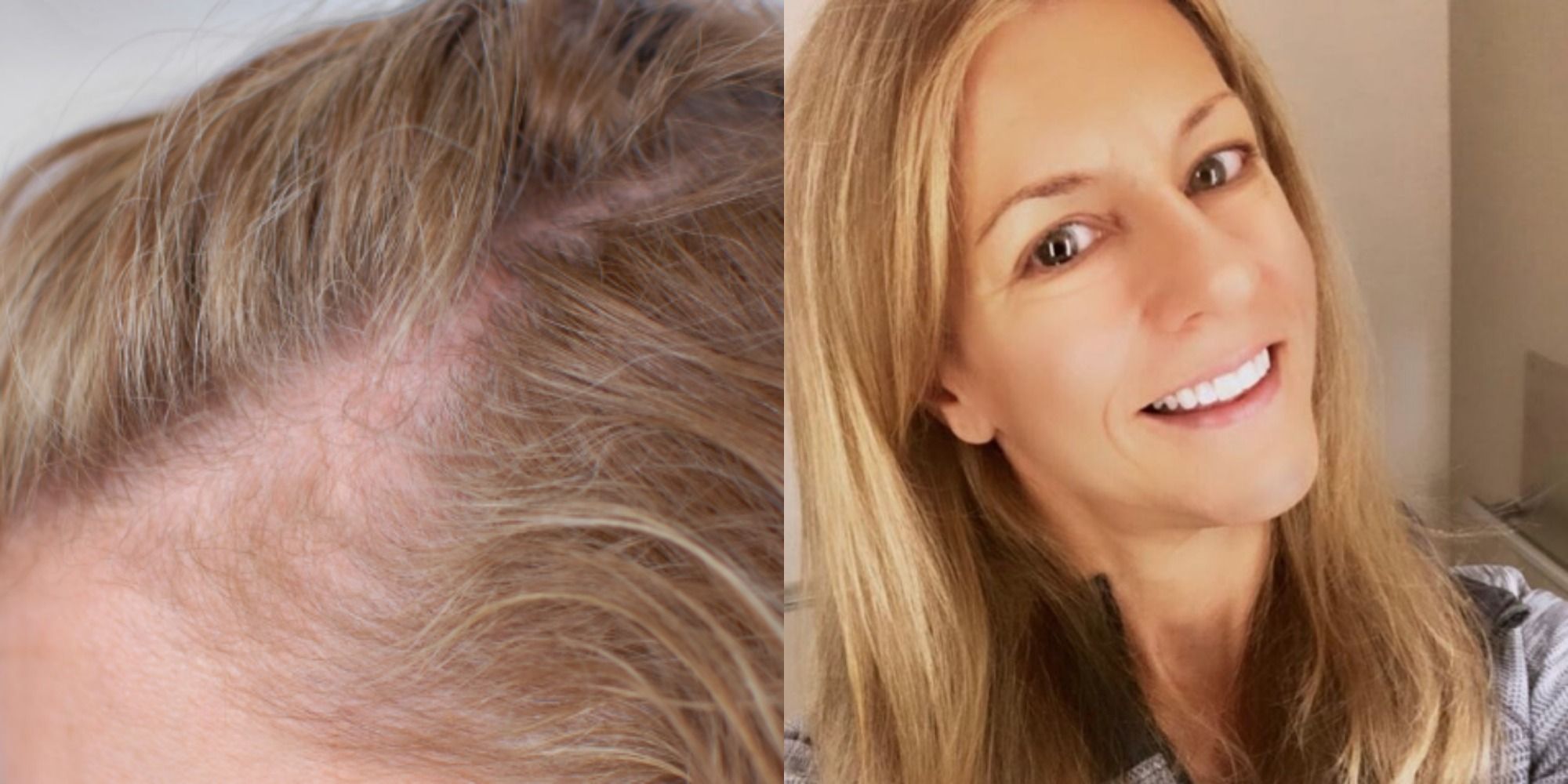 Female Pattern Baldness: Causes and Treatment Options