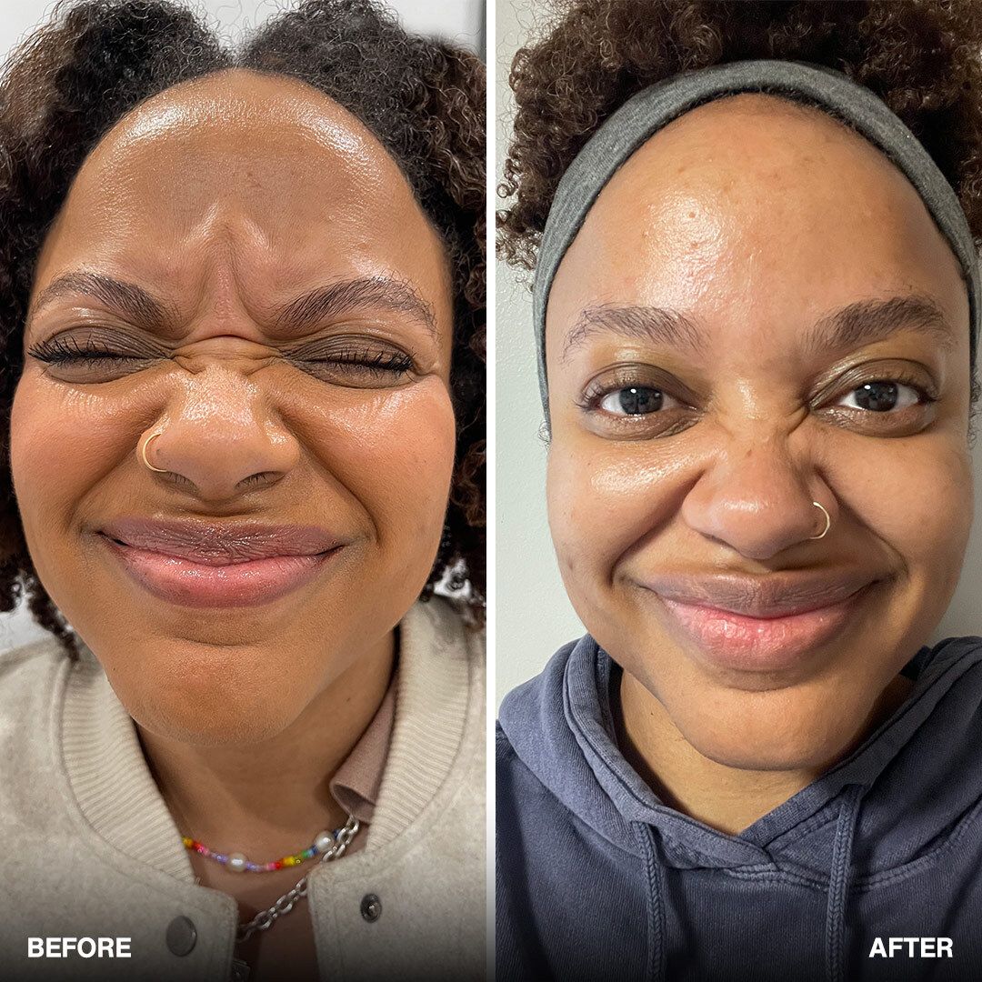botox