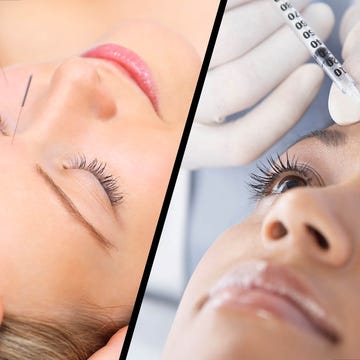 Botox vs acupuncture