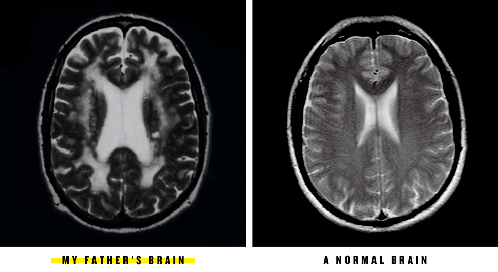 diptych of william's father's brain and a normal brain