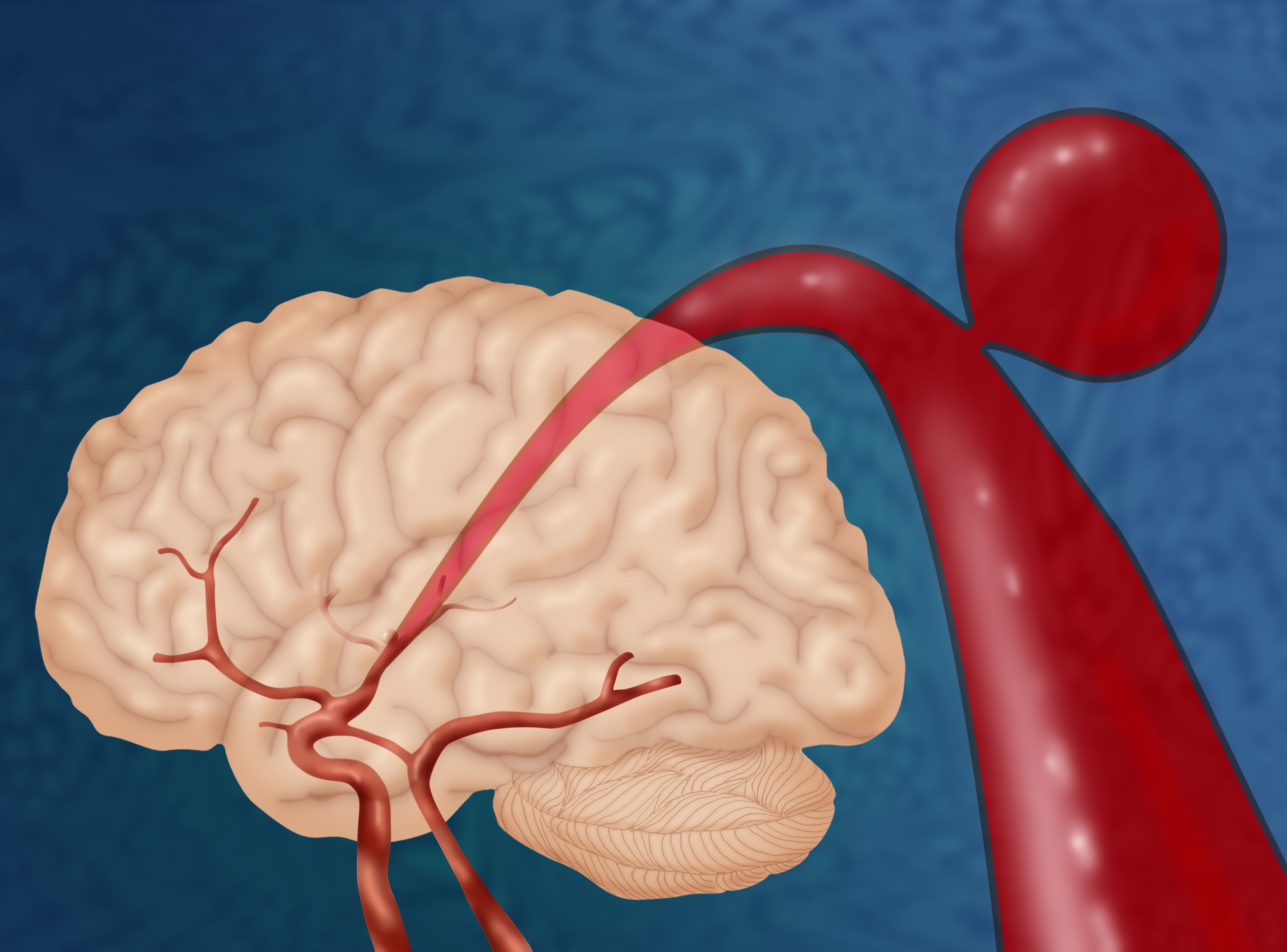Brain Aneurysm
