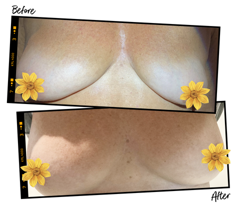 before and after photos of vampire breast lift
