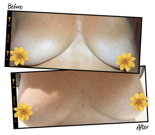 Vampire Breast Lift Treatment Review