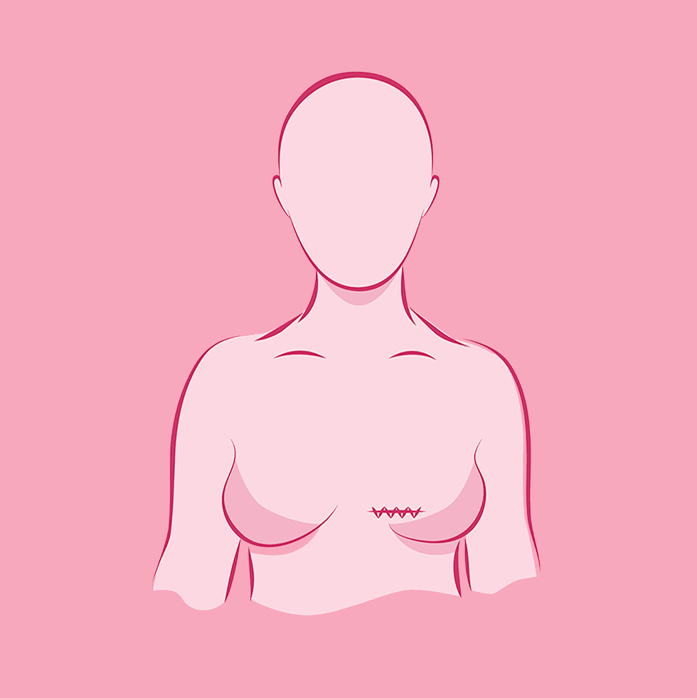 breast cancer treatment surgery