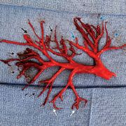 Bronchial Tree Blood Clot