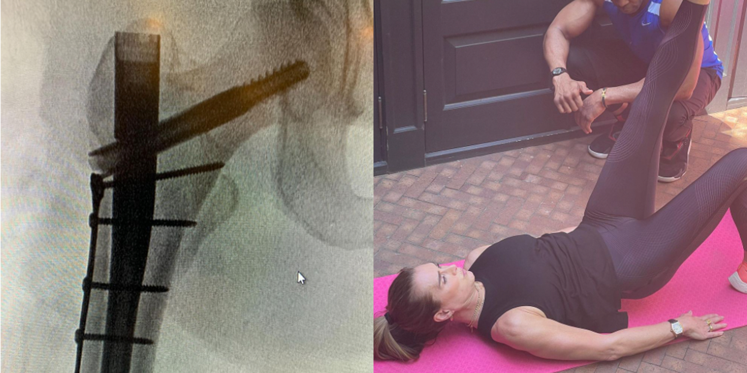 Brooke Shields Shares Post-Surgery X-Ray After Breaking Femur image photo