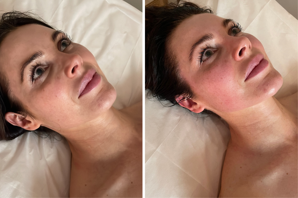 buccal massage tmj sore jaw facelift