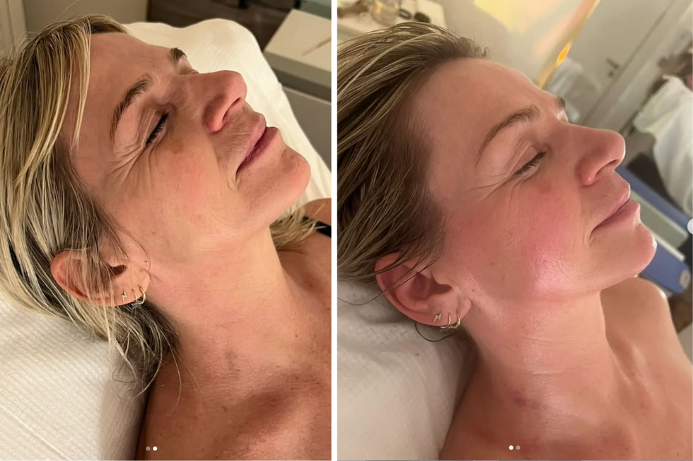 buccal massage jaw pain tmj facelift
