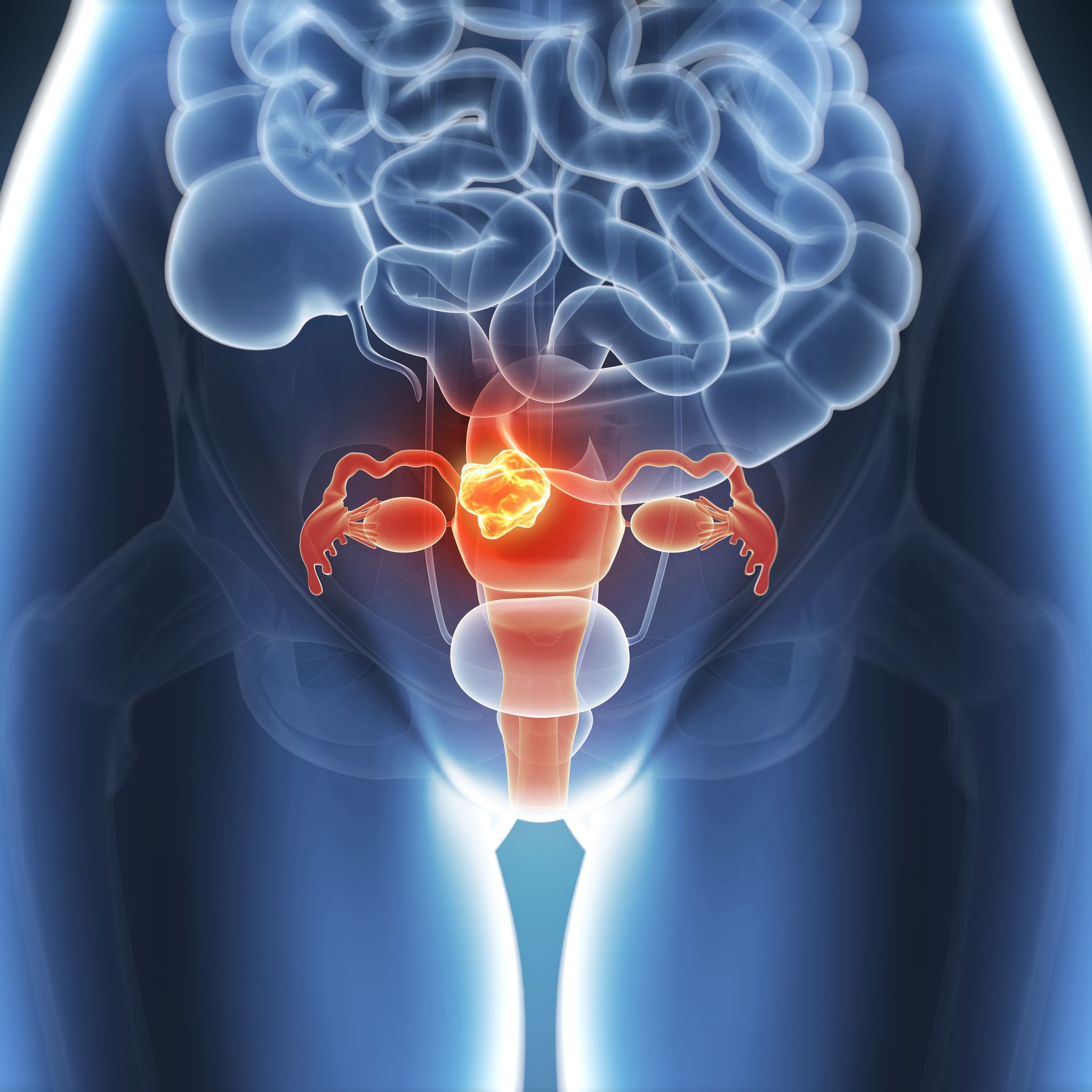 Cancer of the uterus, illustration