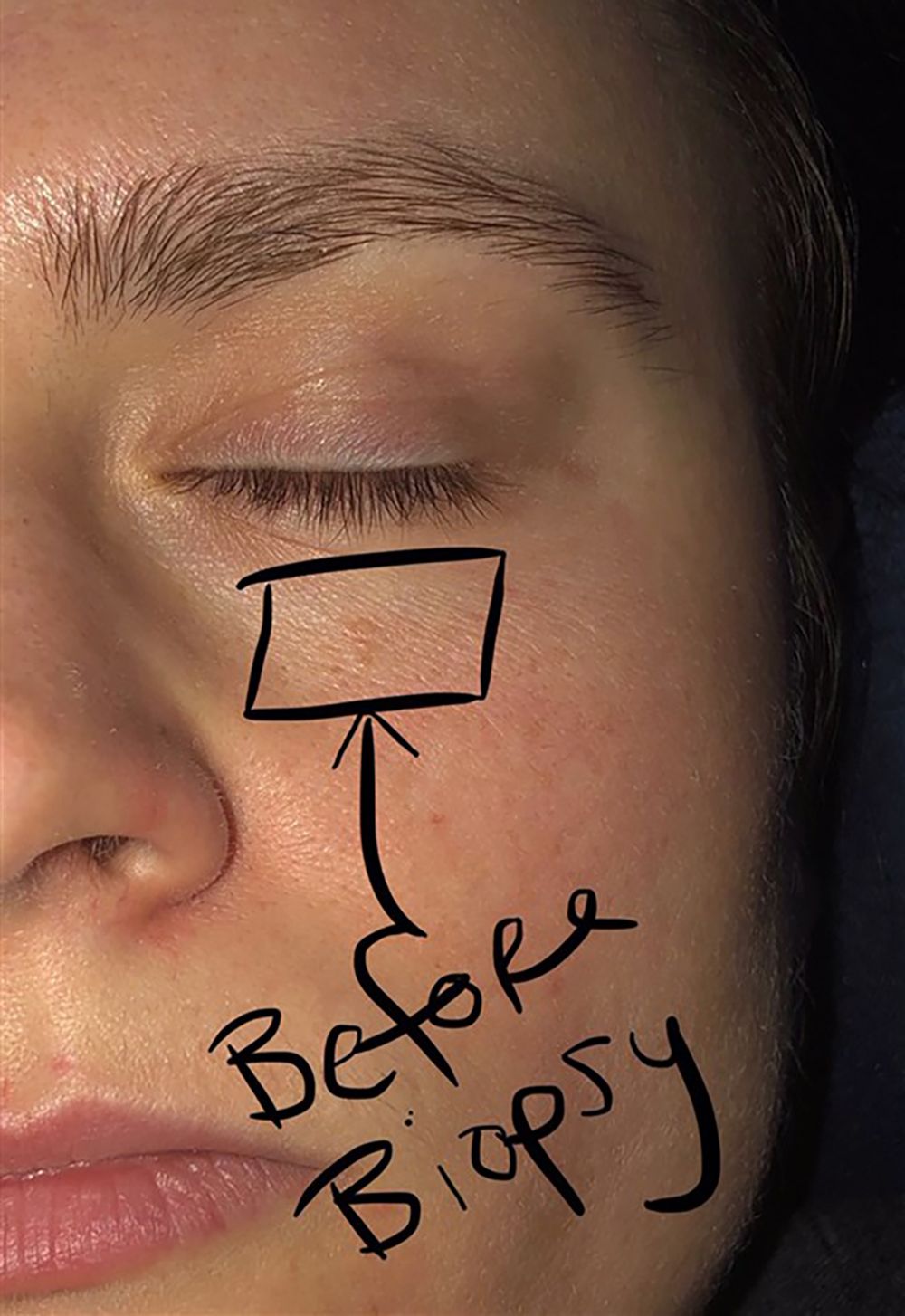 Eye Pimples  Causes Treatments and Prevention Methods  SkinKraft