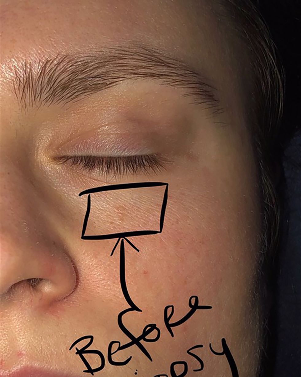 The “Pimple” Under Woman's Eye Turned out to Be Skin