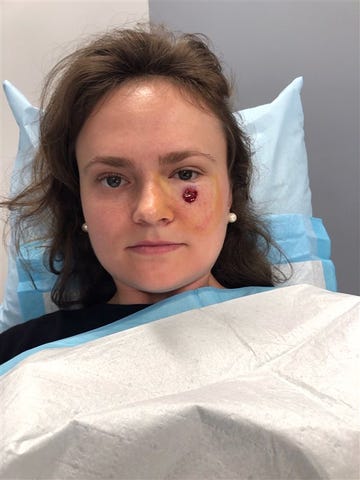 Gibson Miller Skin Cancer Pimple