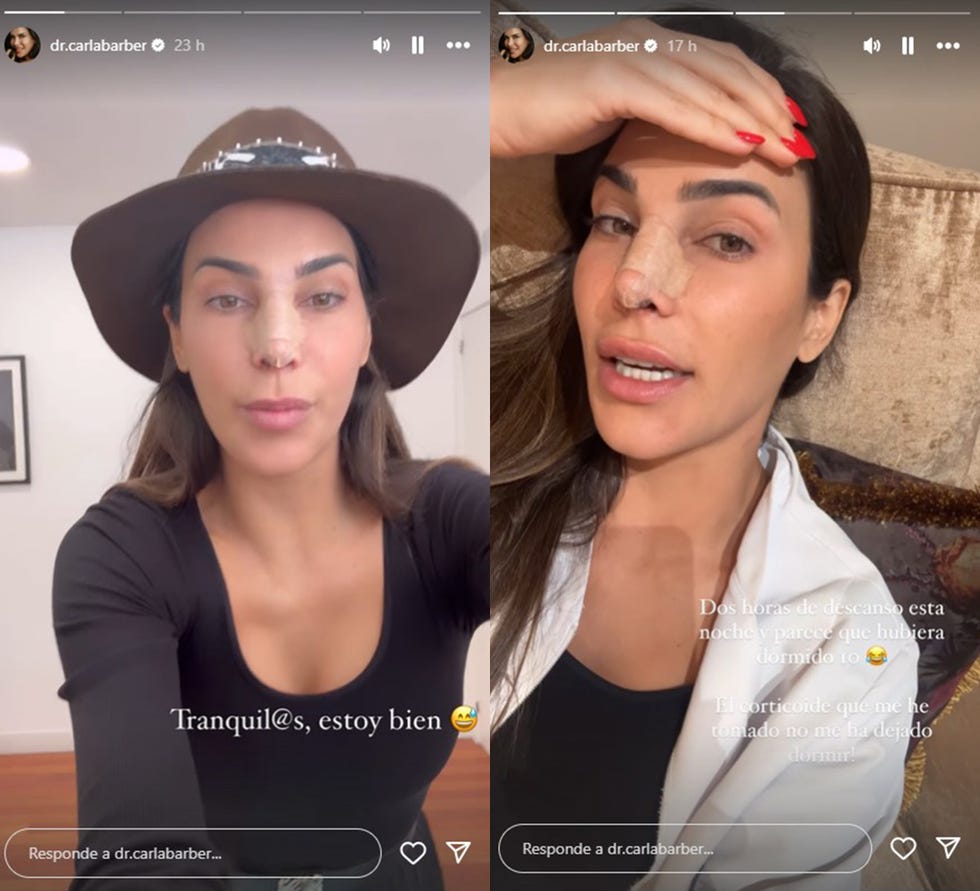 carla barber con la nariz vendada tras un accidente