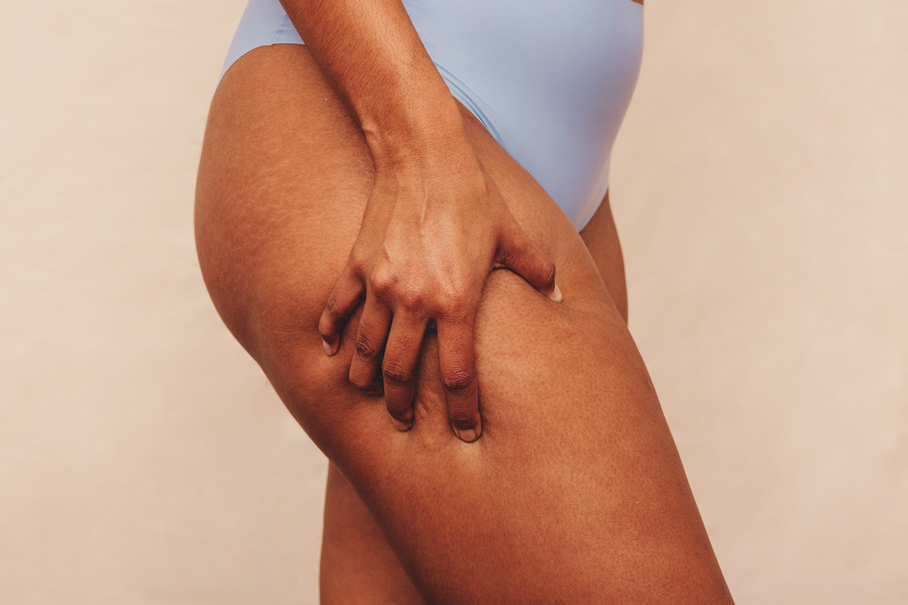 Almost everyone has cellulite, and that's okay