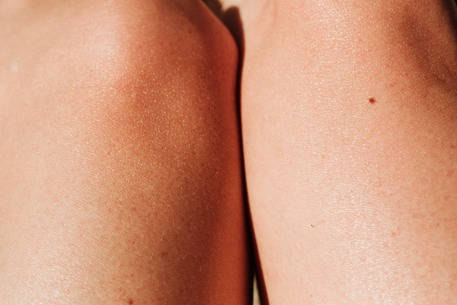 Dark Inner Thigh Chafing: Causes of Discolouration – Thigh Society Canada