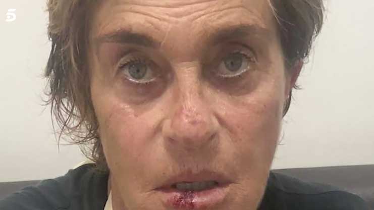 Chelo García Cortés muestra sus heridas tras caerse mientras paseaba a su perrita Maggie