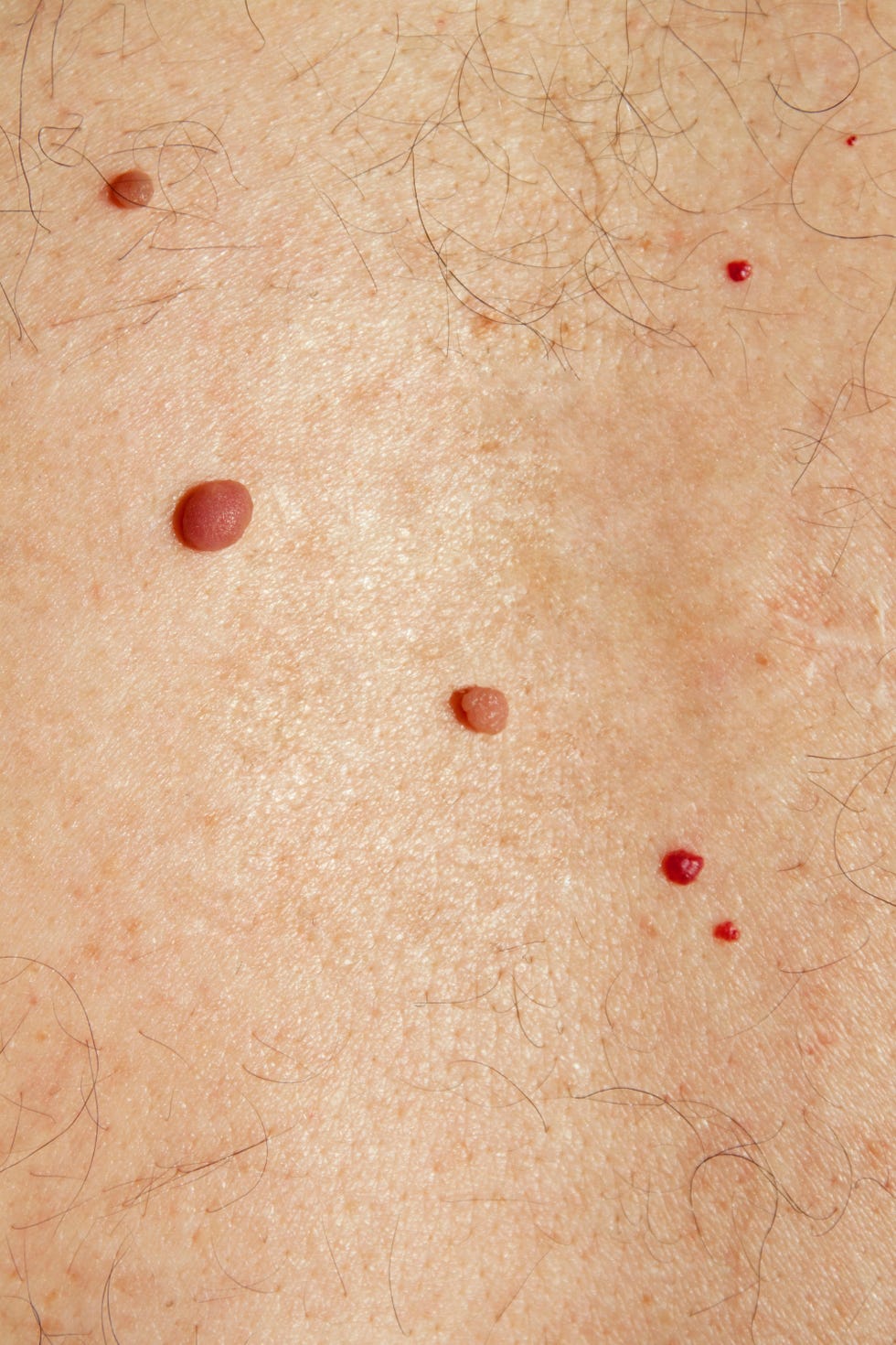 Cherry Angioma cherry angioma