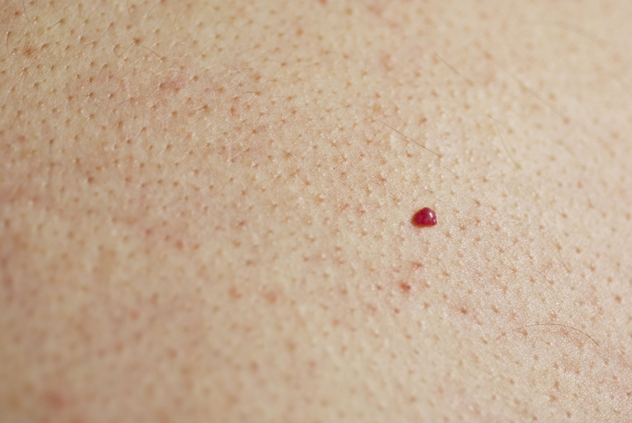 cherry angioma